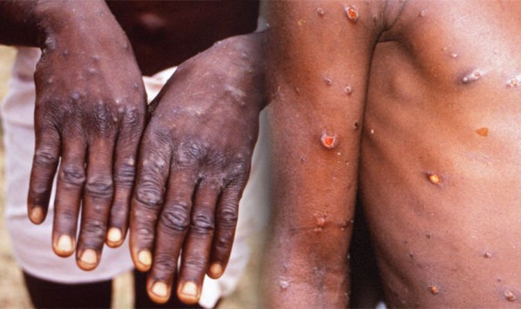 Monkeypox Virus Symptoms and Treatment In Hindi