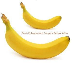 penis-enlargement-surgery-photo