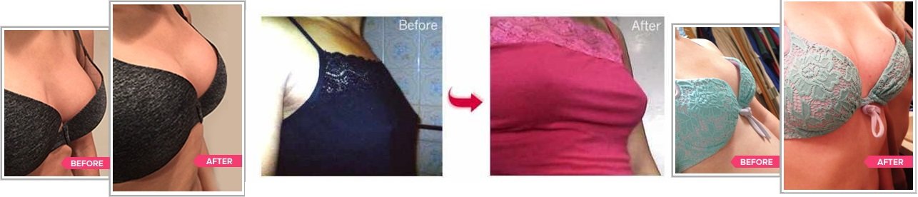 Naturaful Breast Enlargement Result Before & After Photo